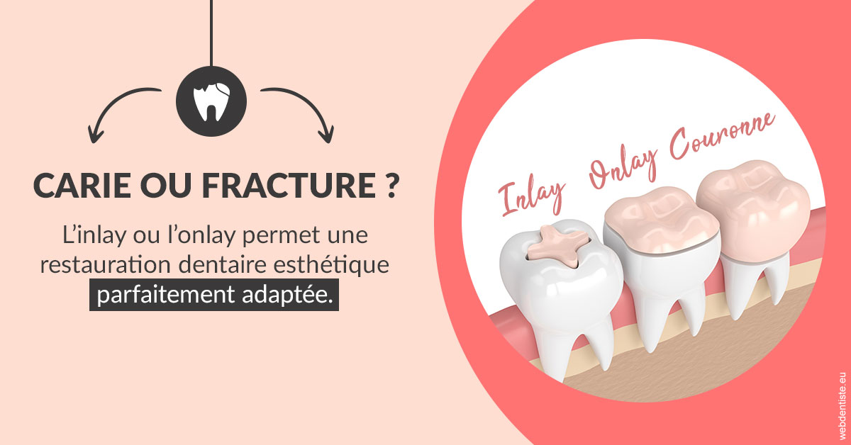 https://www.drigalnahmias.fr/T2 2023 - Carie ou fracture 2