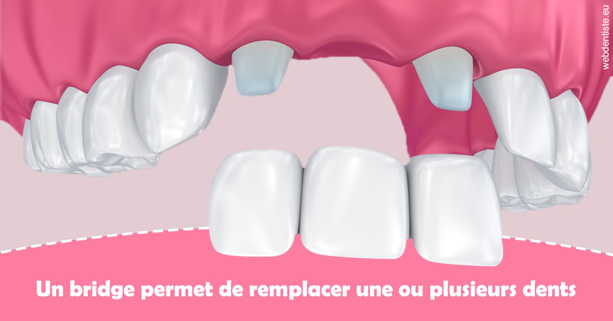 https://www.drigalnahmias.fr/Bridge remplacer dents 2