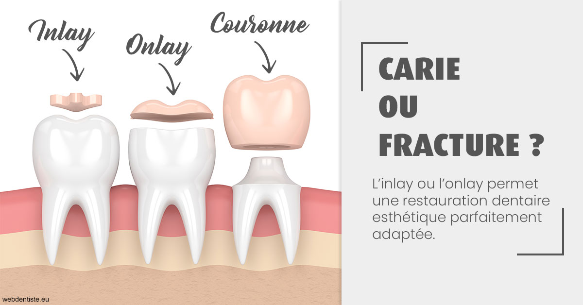 https://www.drigalnahmias.fr/T2 2023 - Carie ou fracture 1