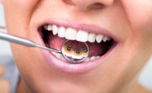L'orthodontie invisible avec Invisalign