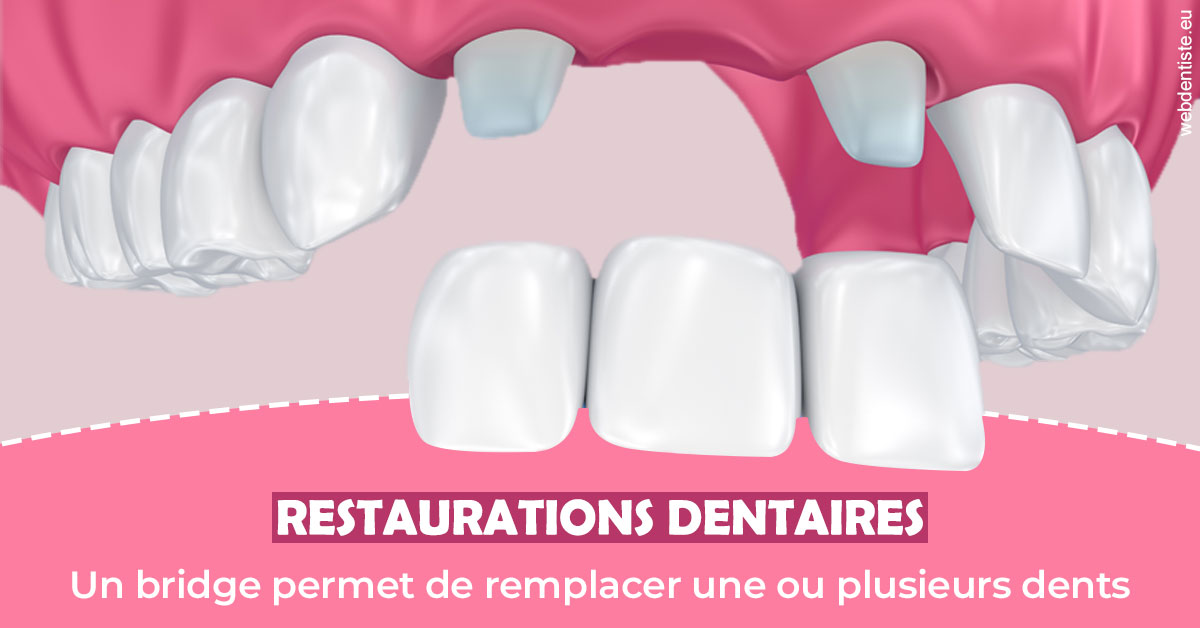 https://www.drigalnahmias.fr/Bridge remplacer dents 2