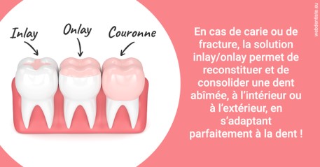 https://www.drigalnahmias.fr/L'INLAY ou l'ONLAY 2