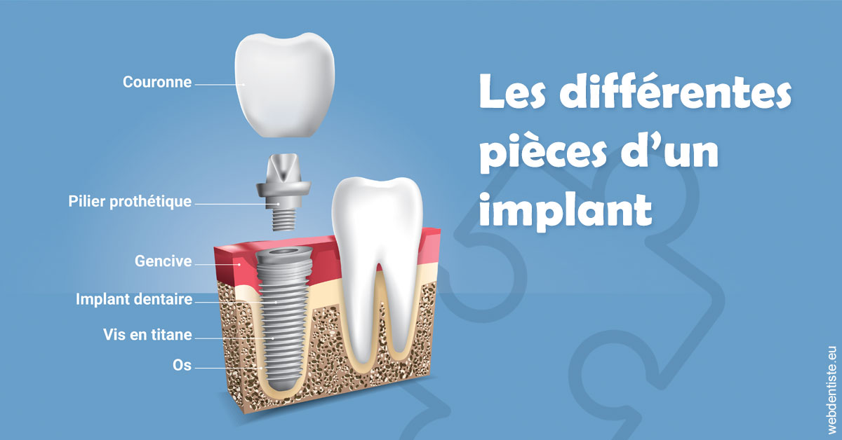 https://www.drigalnahmias.fr/Les différentes pièces d’un implant 1