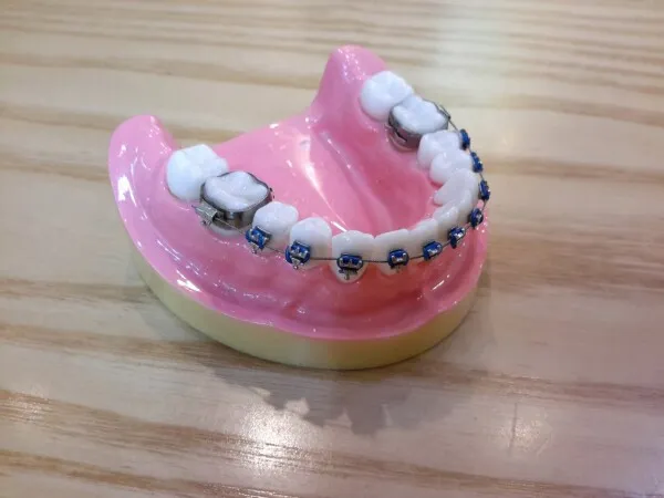 Mini-vis en orthodontie