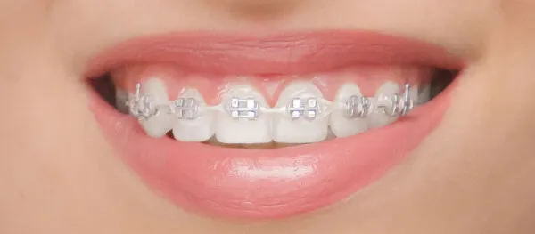 Les sept familles d’appareillages orthodontiques : les appareils multiattache