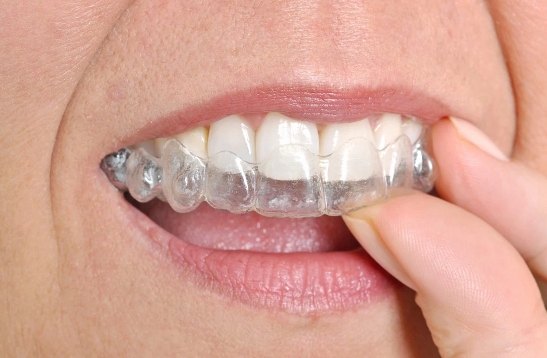 Les sept familles d’appareillages orthodontiques : les gouttières