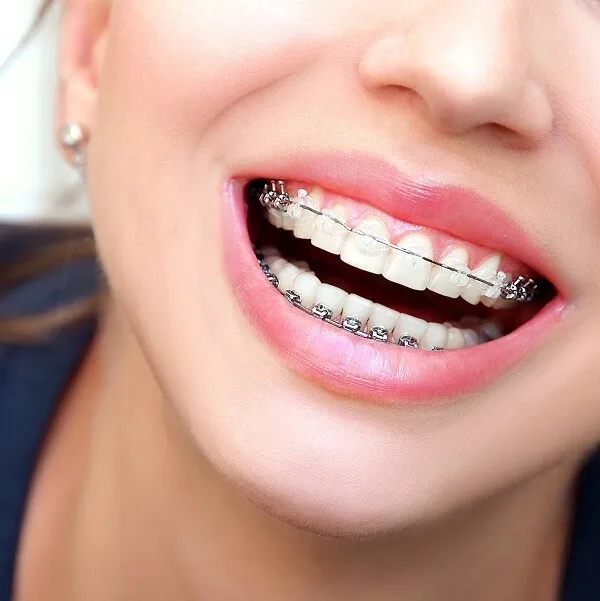 Appareils orthodontiques autoligaturants